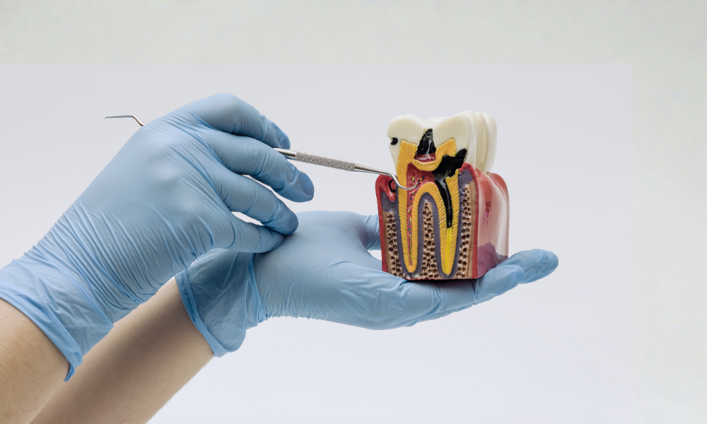 Endodoncia Moderna en CleverSalud: Adiós al Dolor Dental